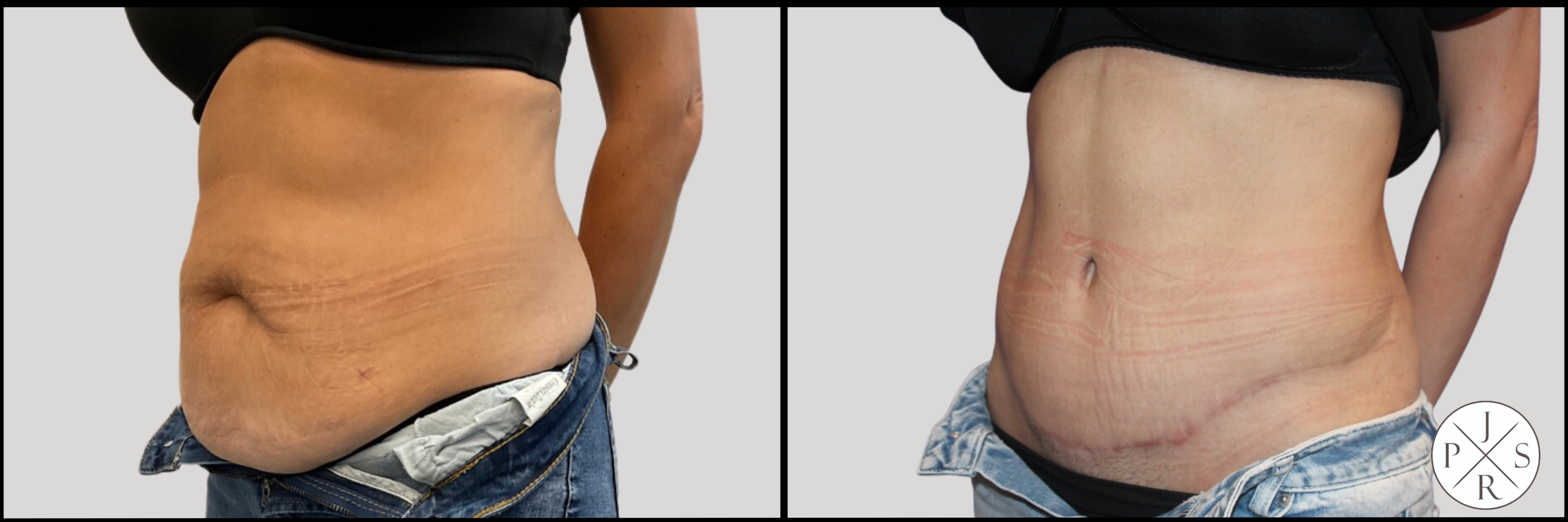 Abdominoplasty Before & After Image